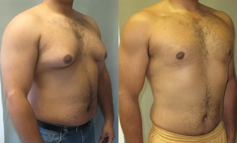 Gynecomastia in Dubai